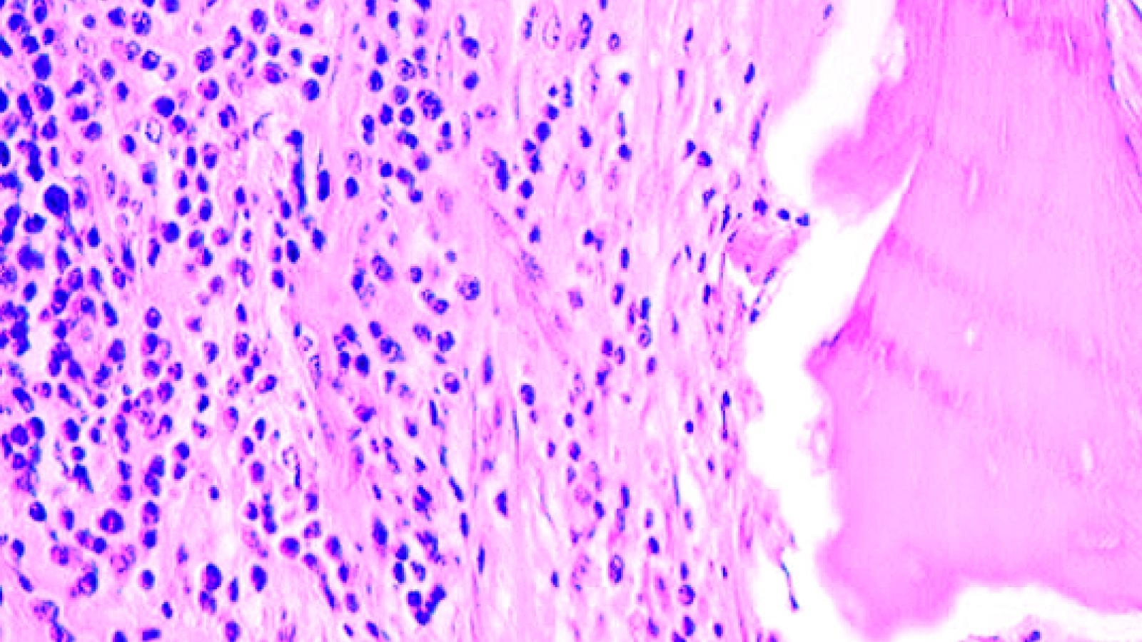 osteomyelitis%20chronic%20type%20micro.jpg