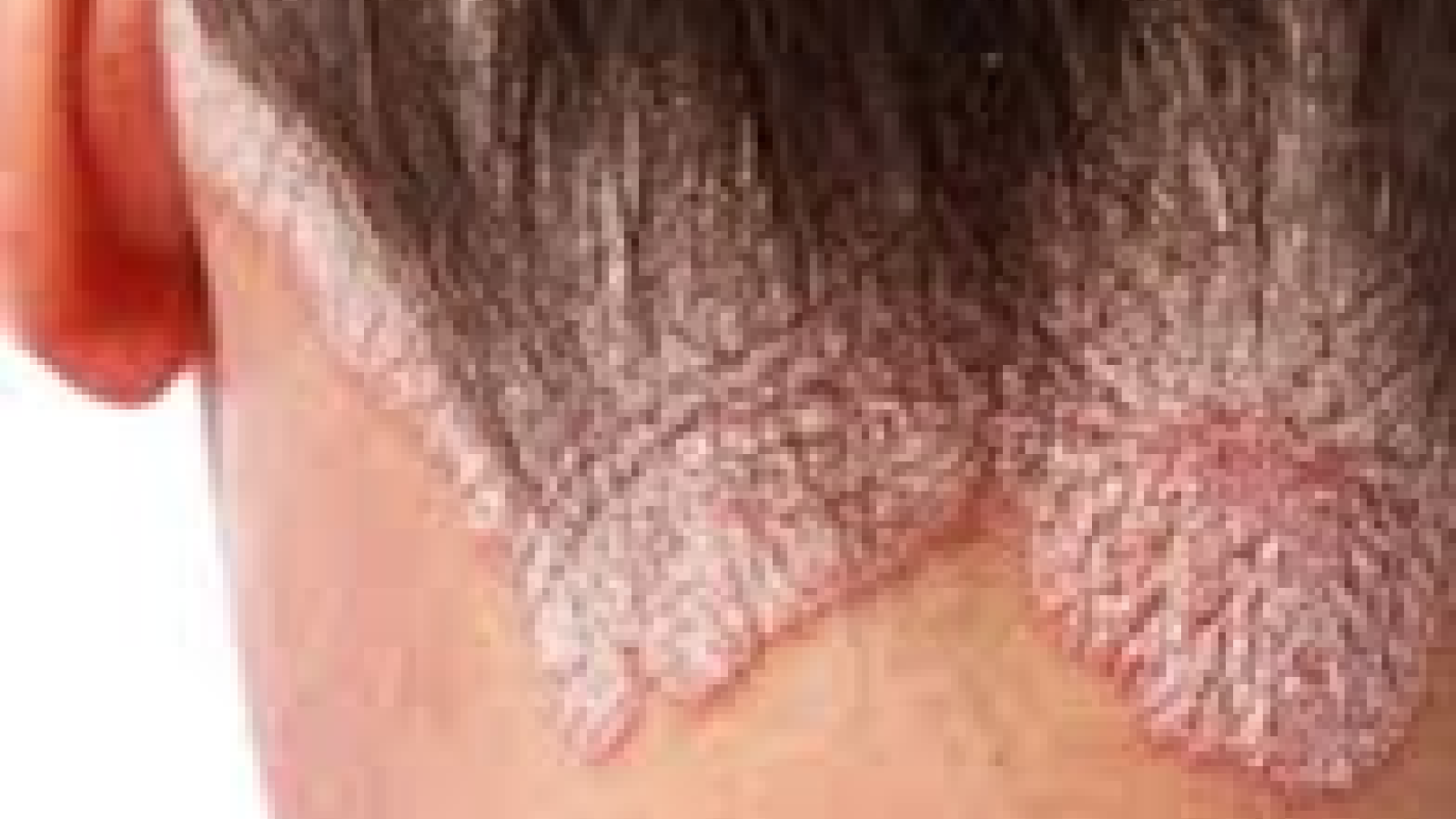 psoriasis.NPF_.png