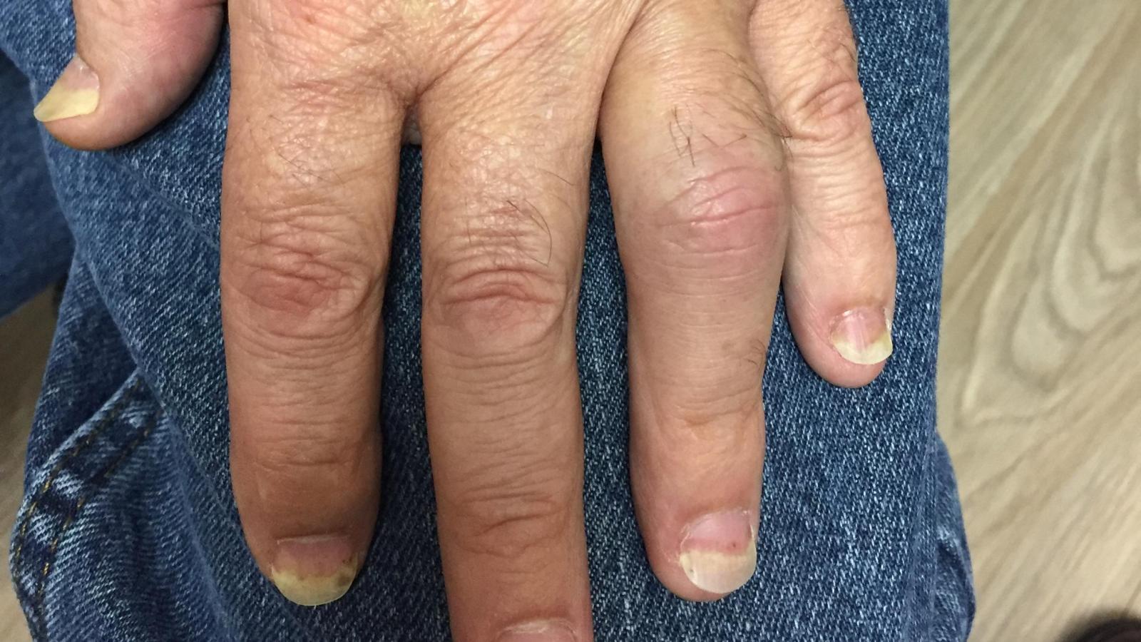 psoriatic.PIP_.JPG
