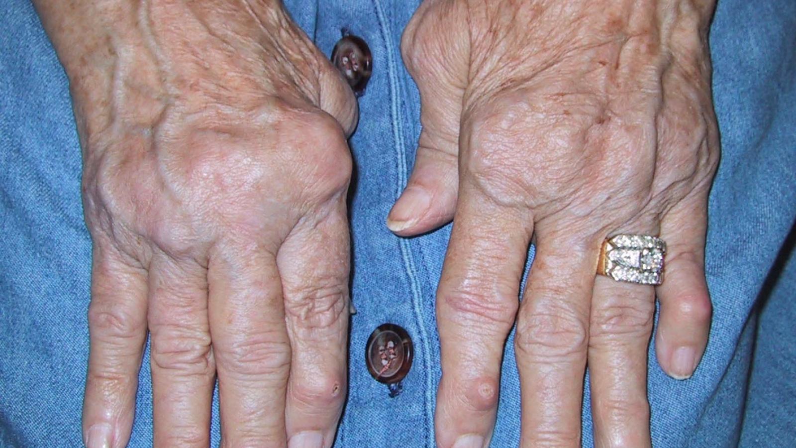 rahandnodules.JPG