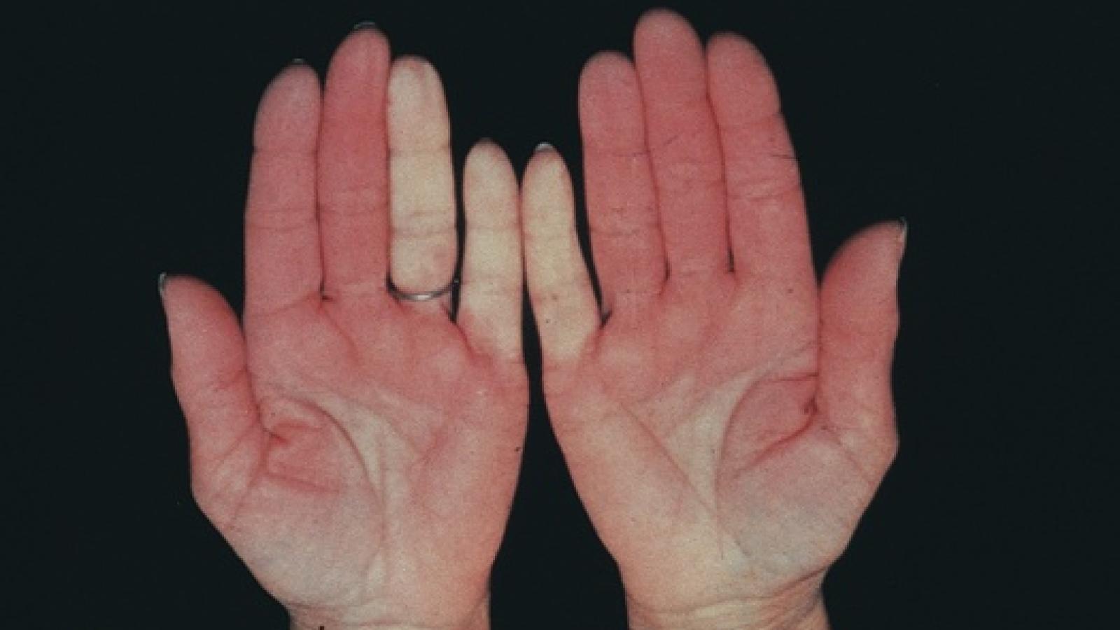 raynaud_0.jpg