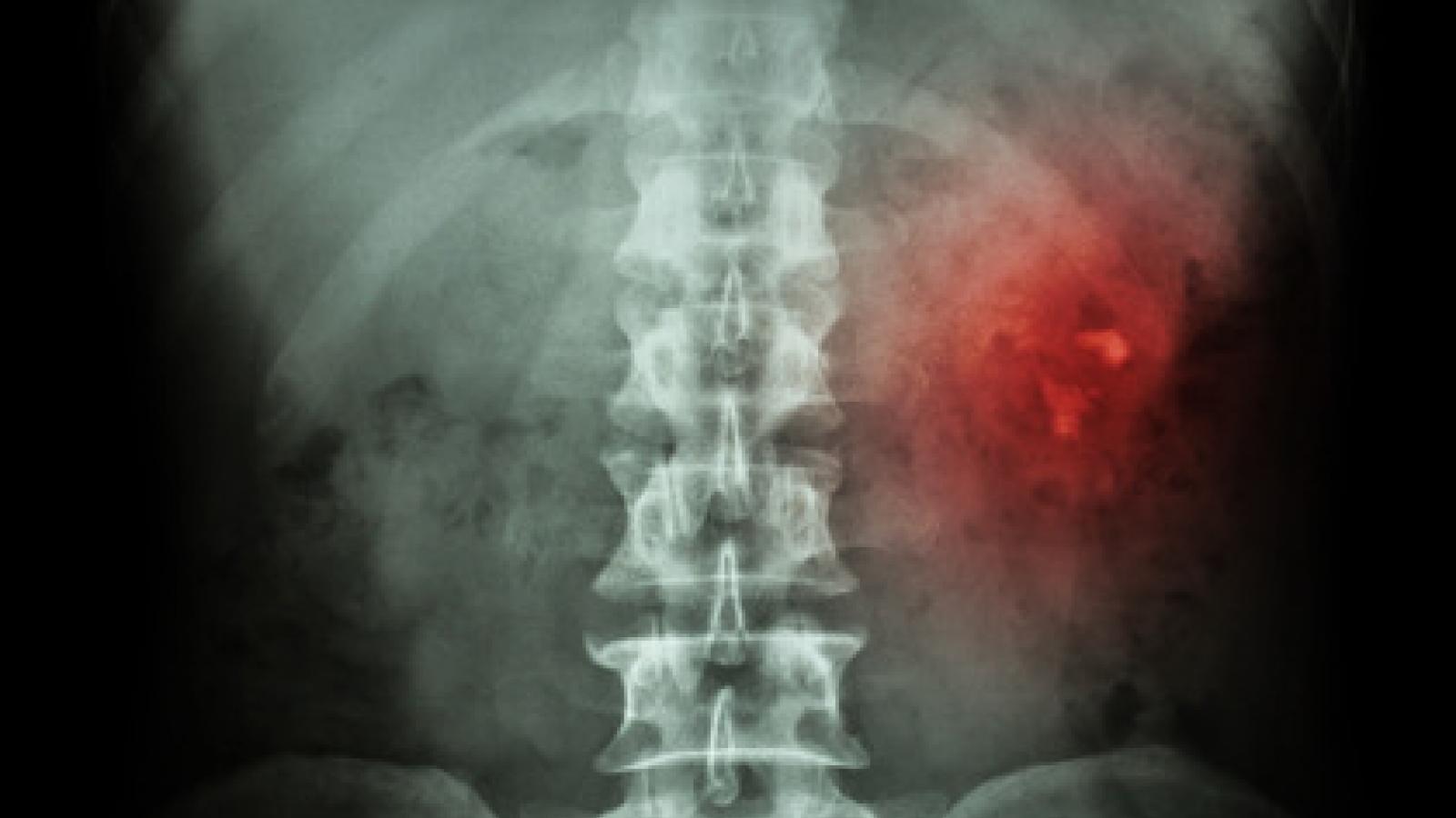 renal.stone_.LBP_.jpg