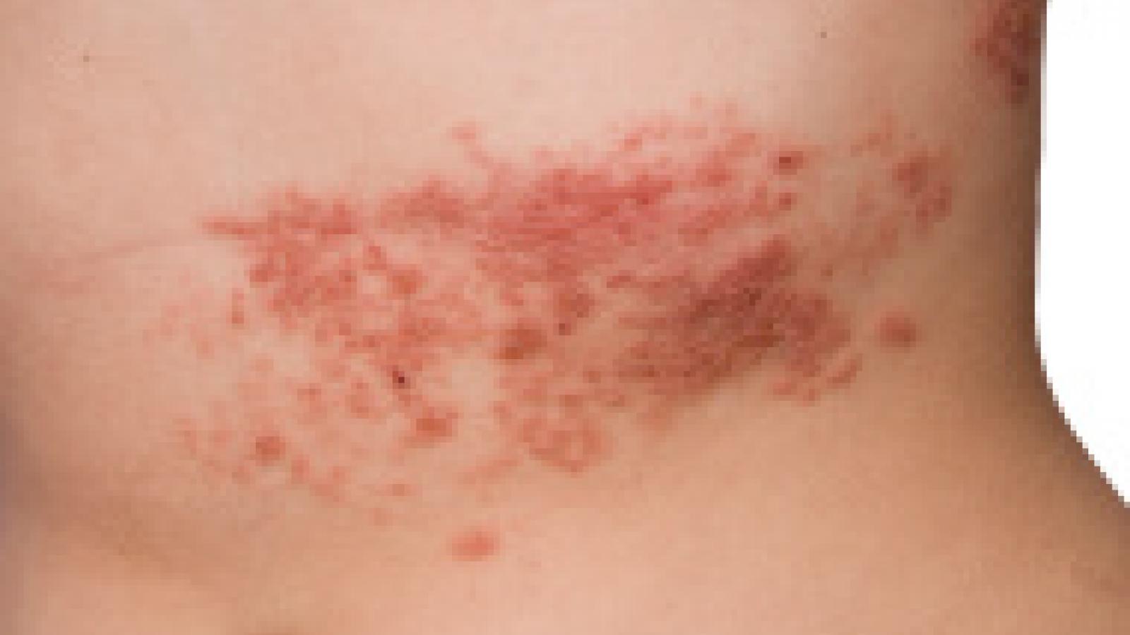 shingles2.jpg