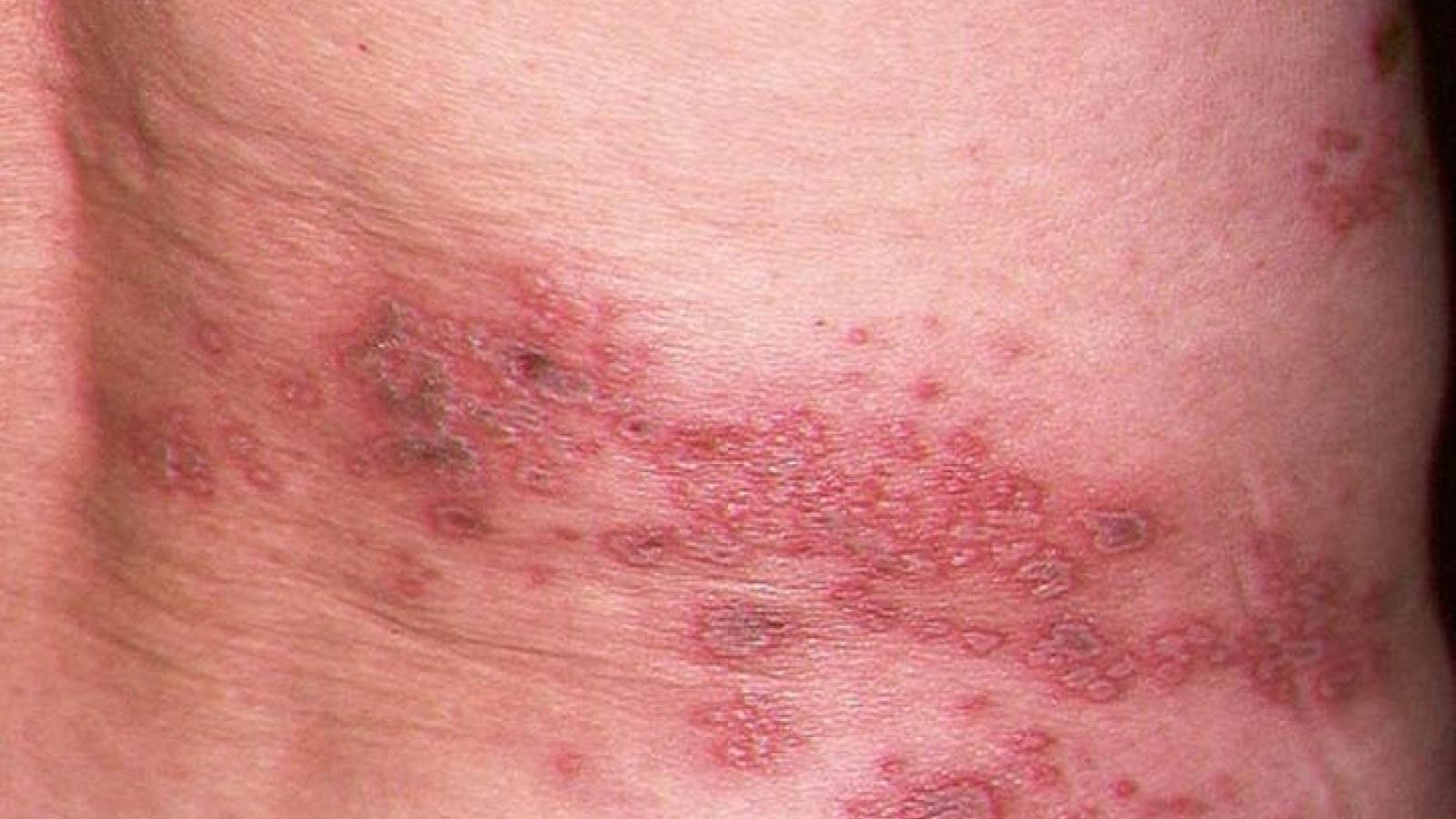 shingles_0.jpg