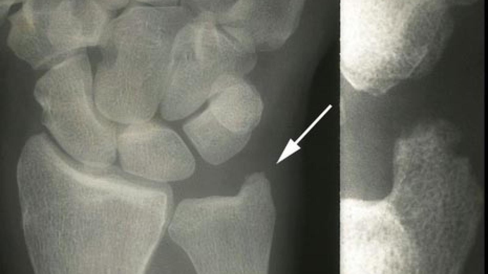 styloid2.JPG