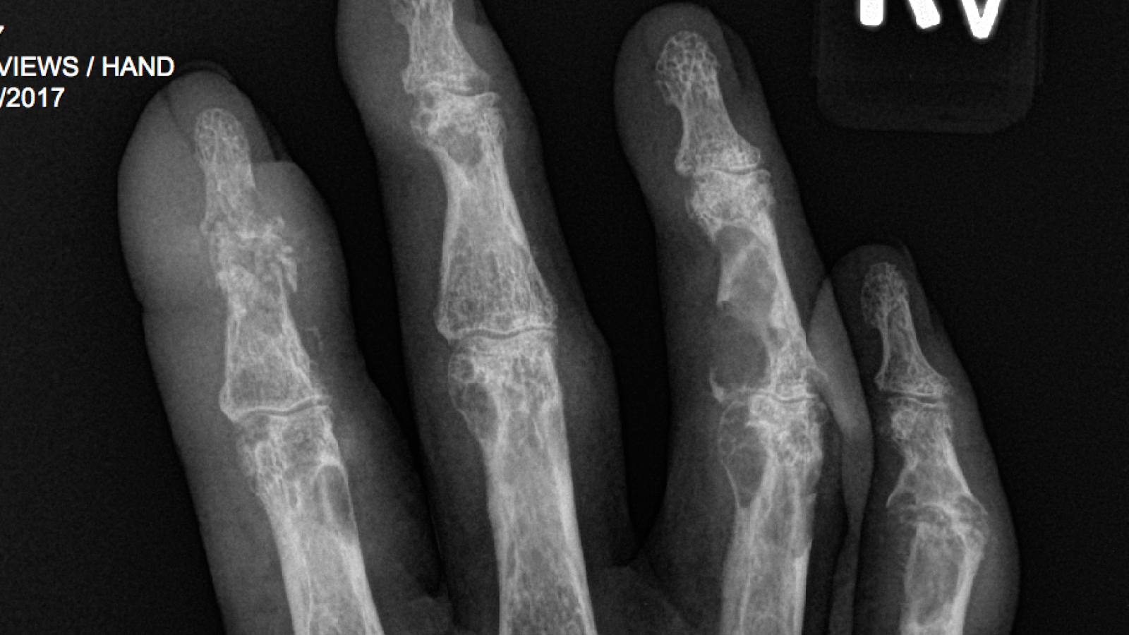 tophaceous.gout_.baraf_.png