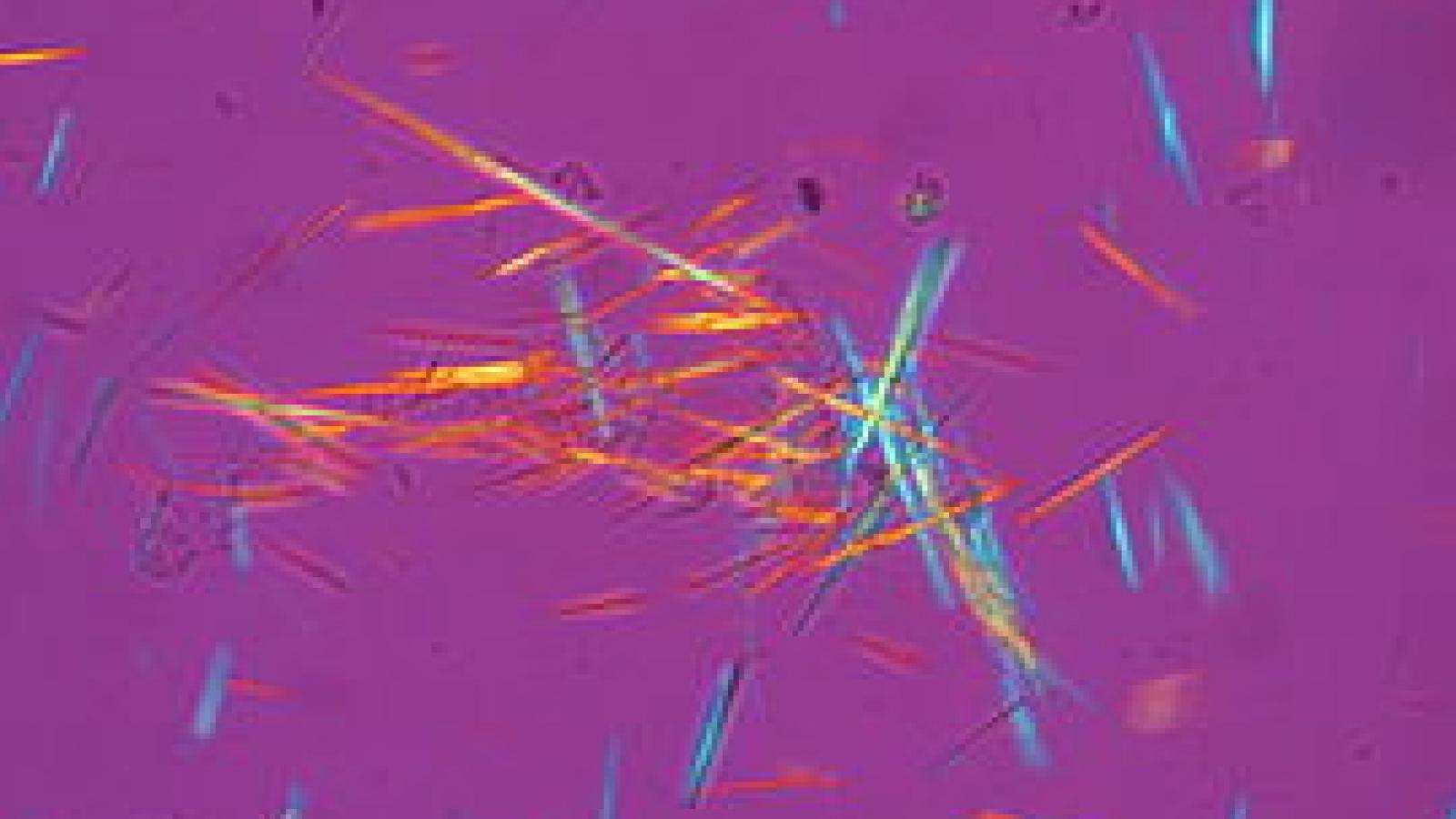 uric%20acid.crystals.gout_.JPG