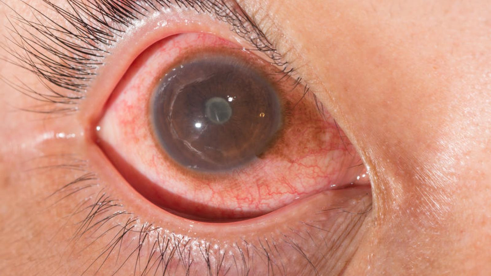 uveitis.3.jpg