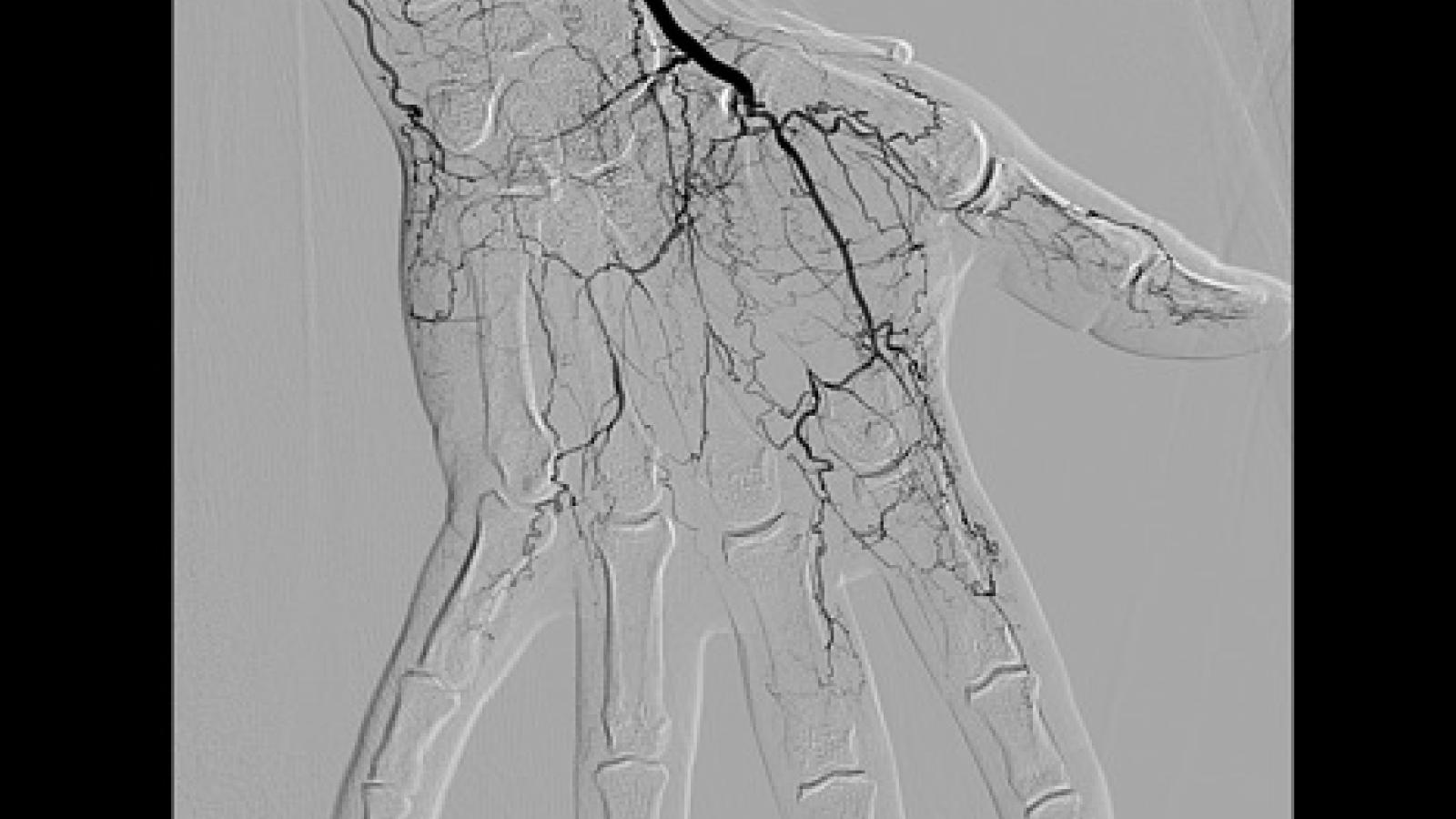 vasculitis.MRA_.jpg