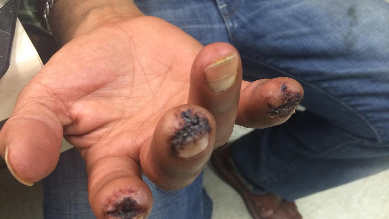 vasculitis.digitial.jpg