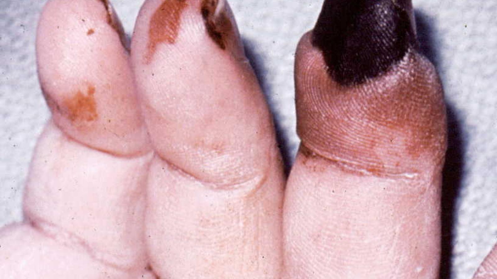 vasculitis.jpg