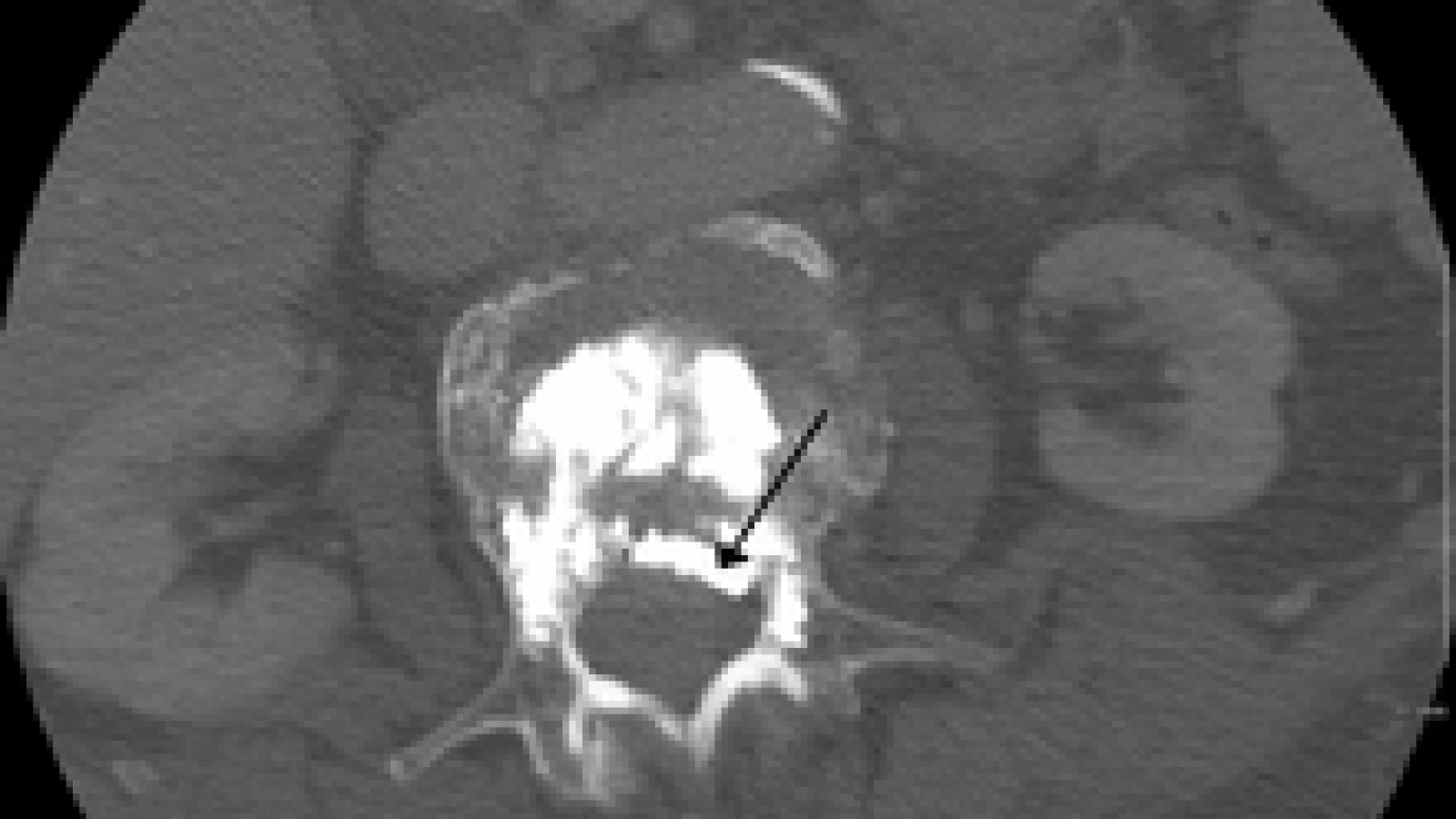 vertebroplasty.png
