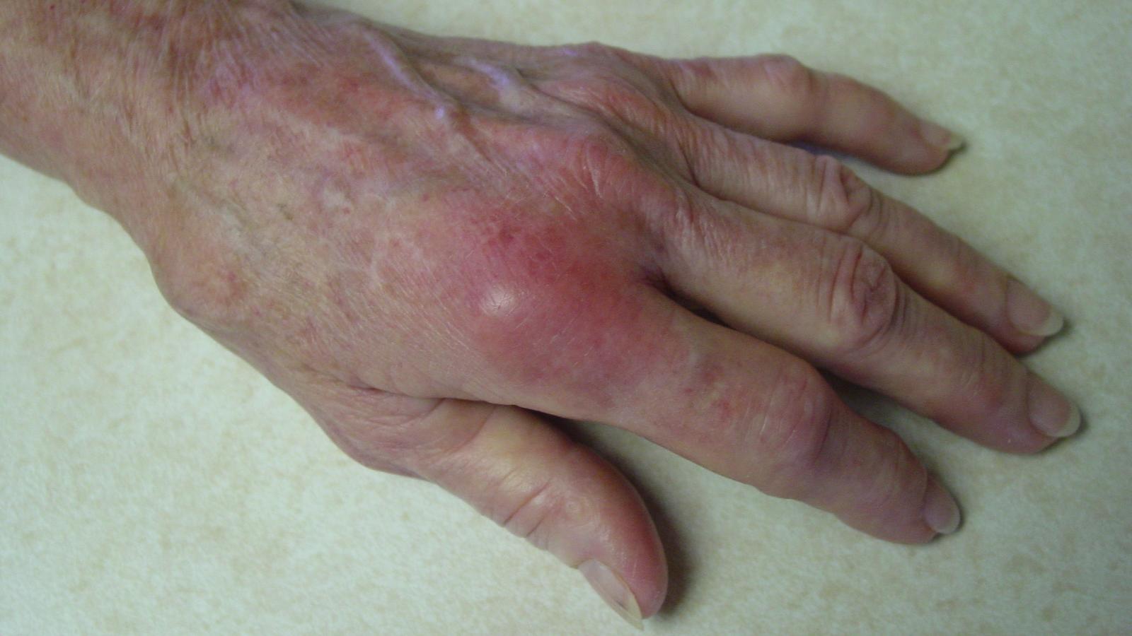 RA.gout.hand.MCP