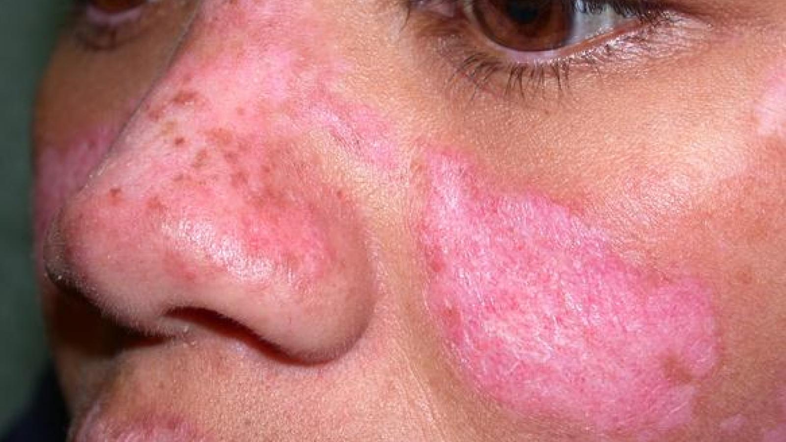 DLE discoid lupus