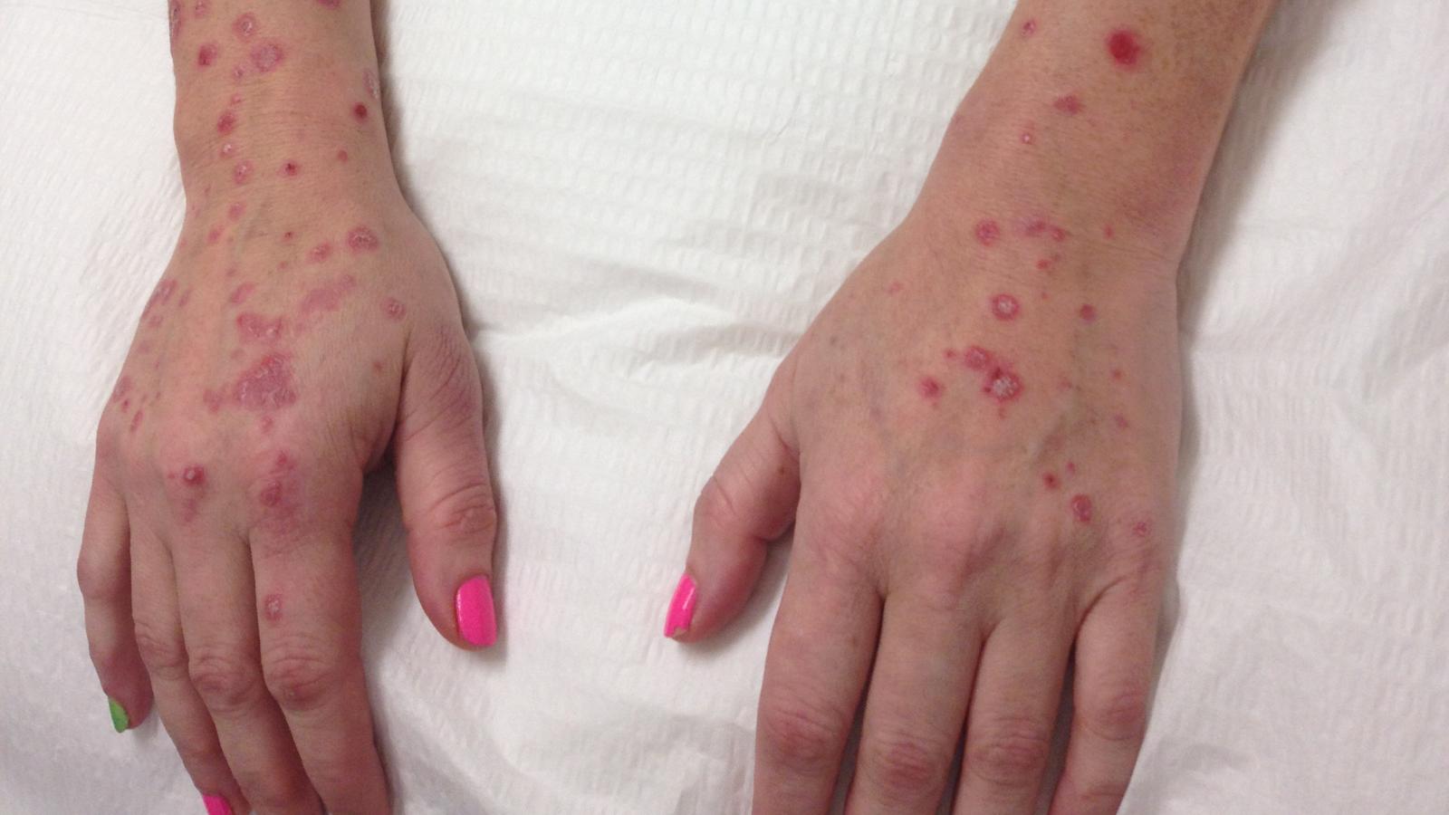 Psoriasis, arms, PsA