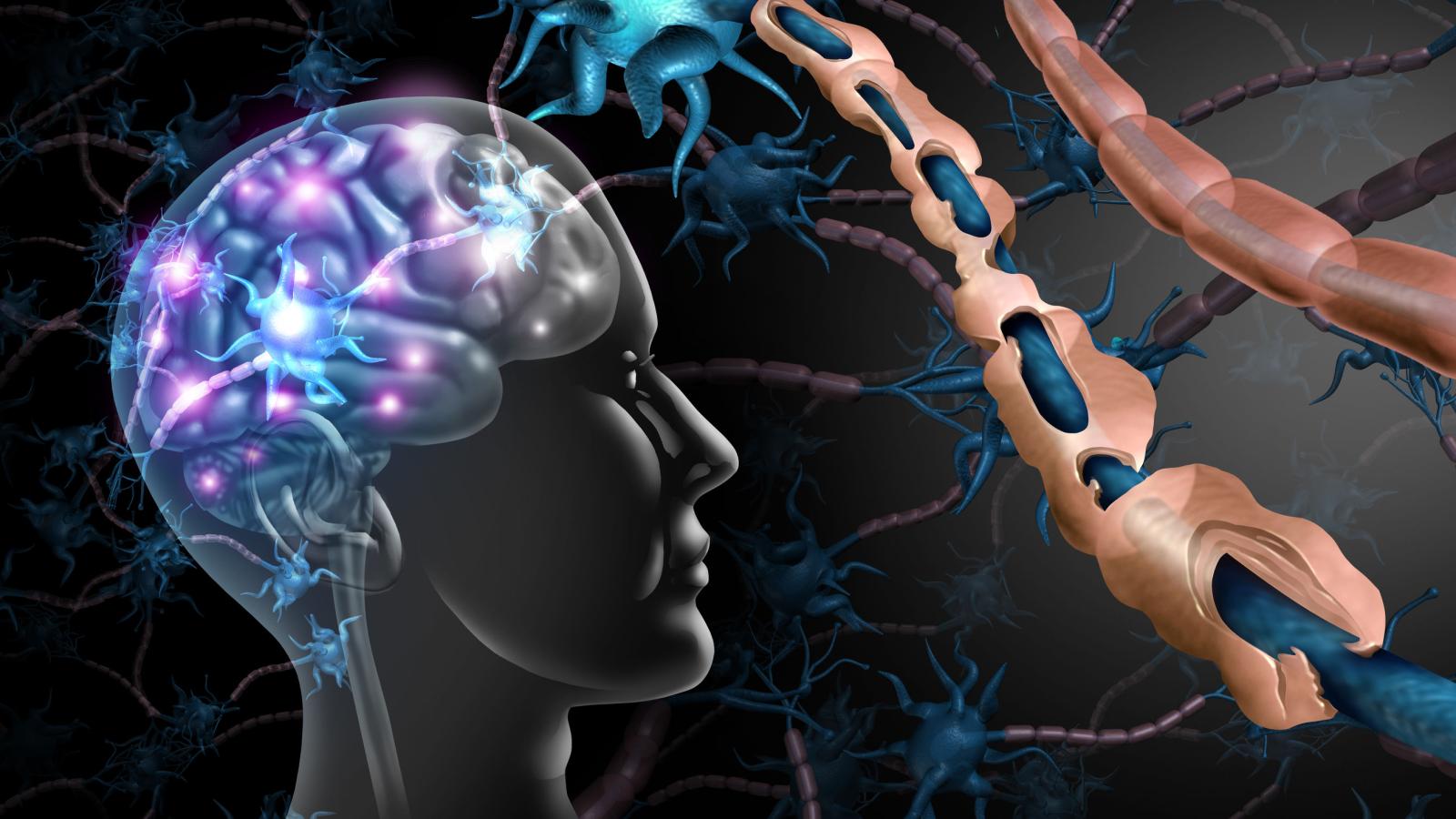 MS, multiple, sclerosis, demyelinating, brain, plaque