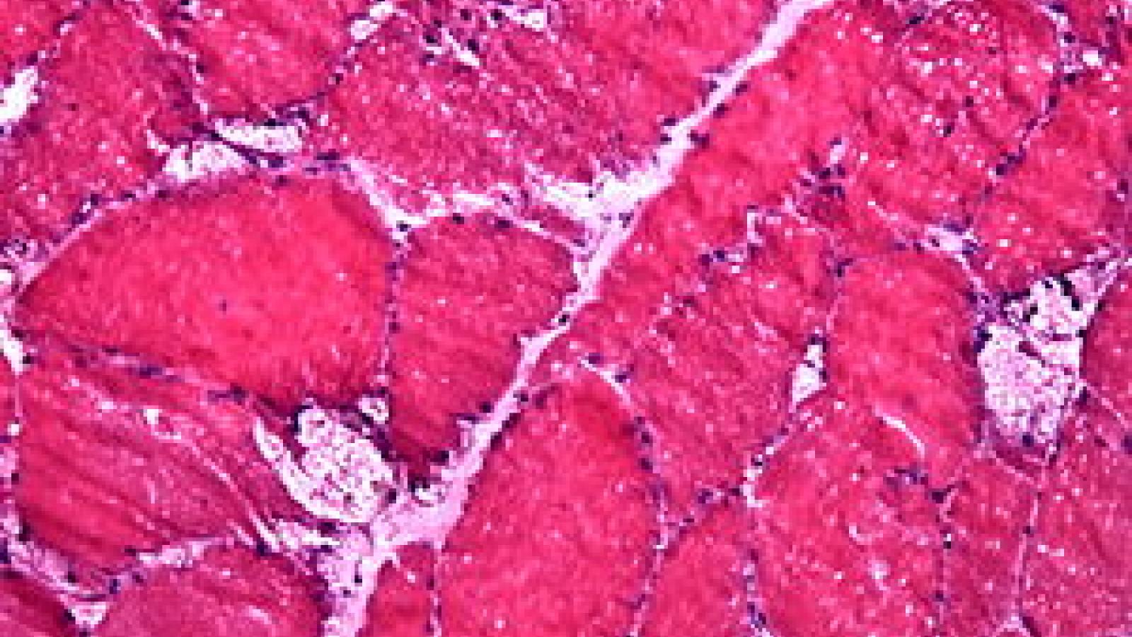 pompe myopathy glycogen muscle