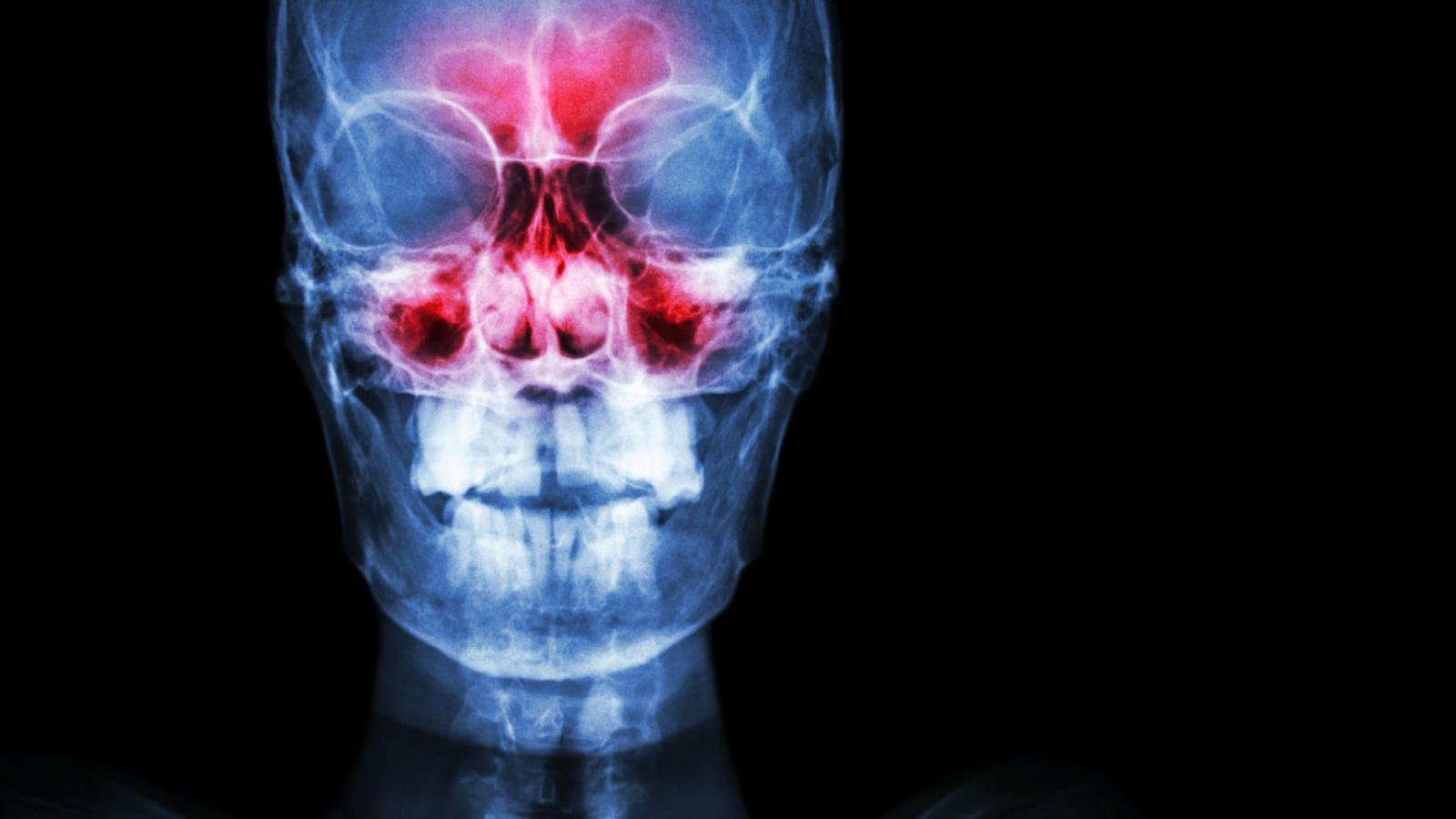Sinusitis Xray maxillary skull