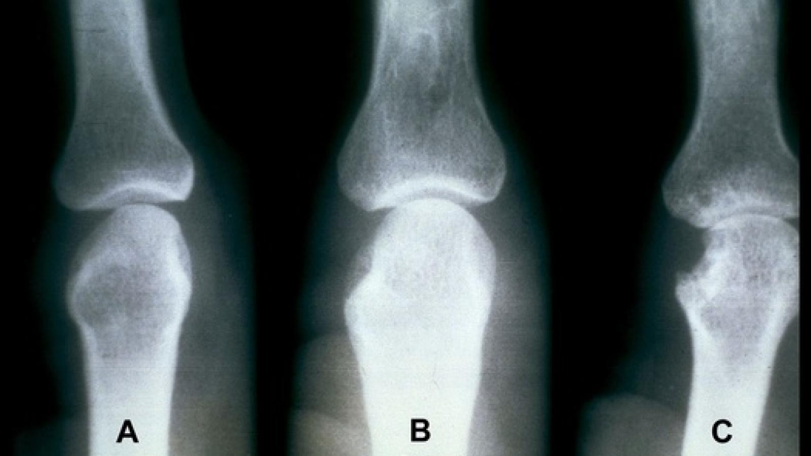 RA erosions bone ACR