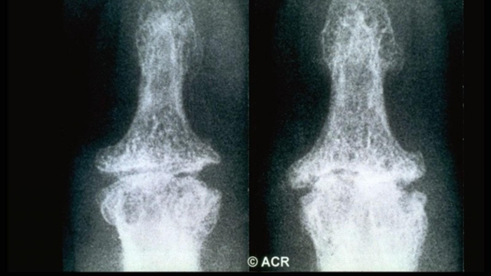 OA, erosive, inflammatory, DIP