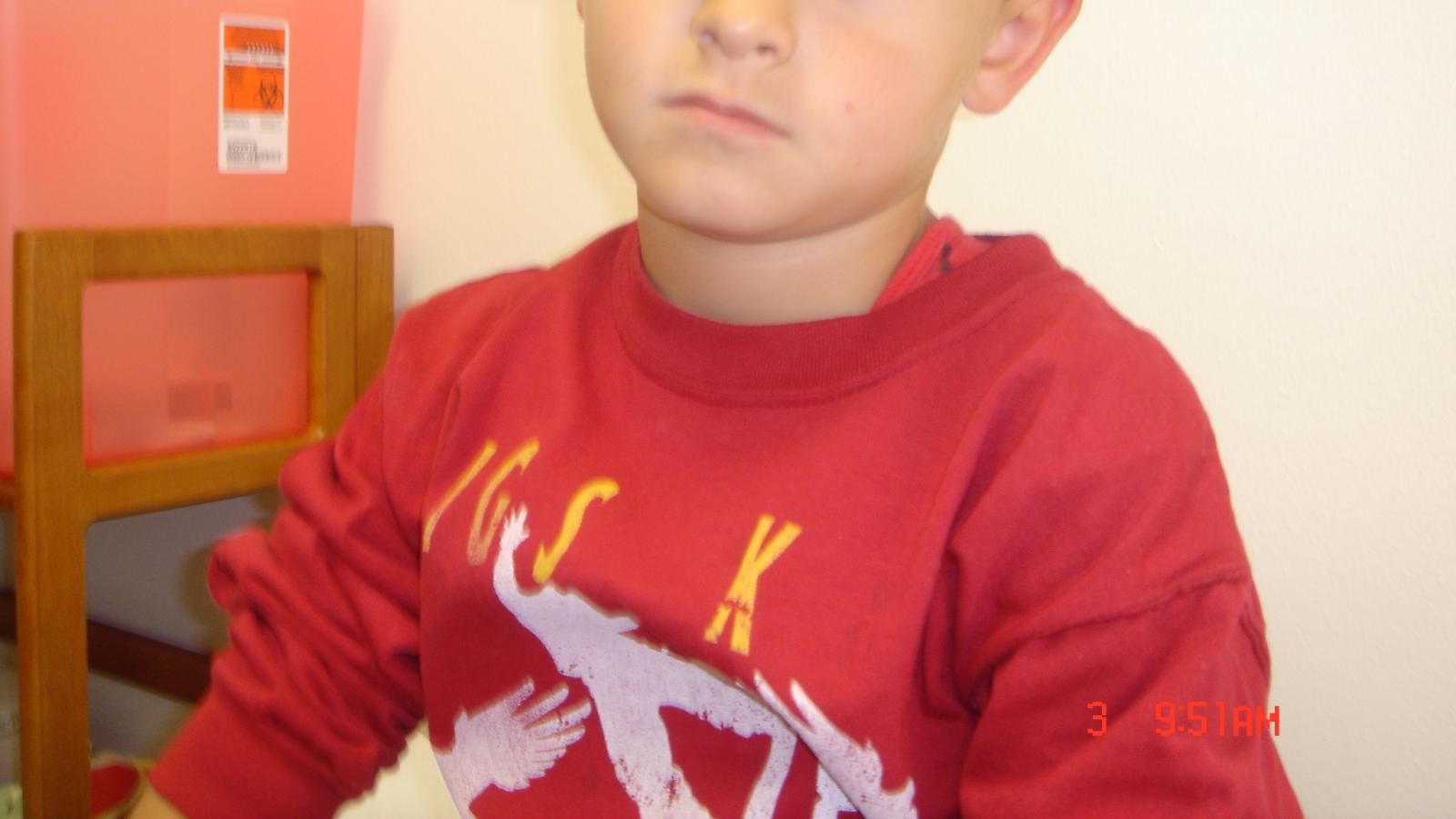 kid, lupus, pediatric