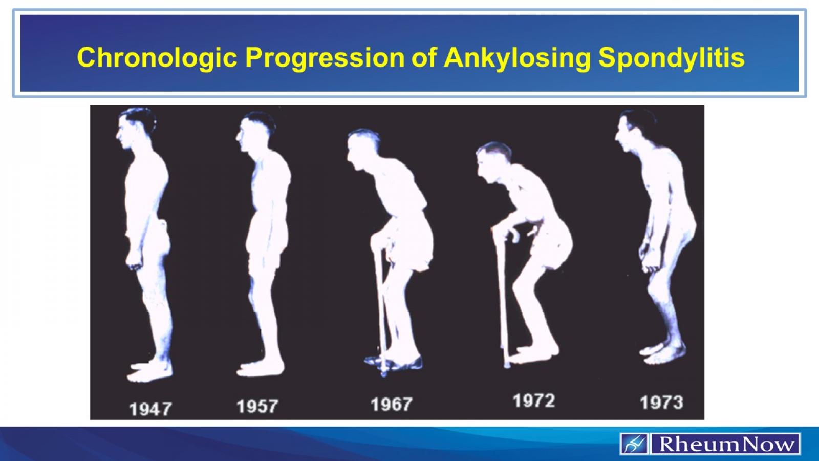 Chronologic Progression of Ankylosing Spondylitis
