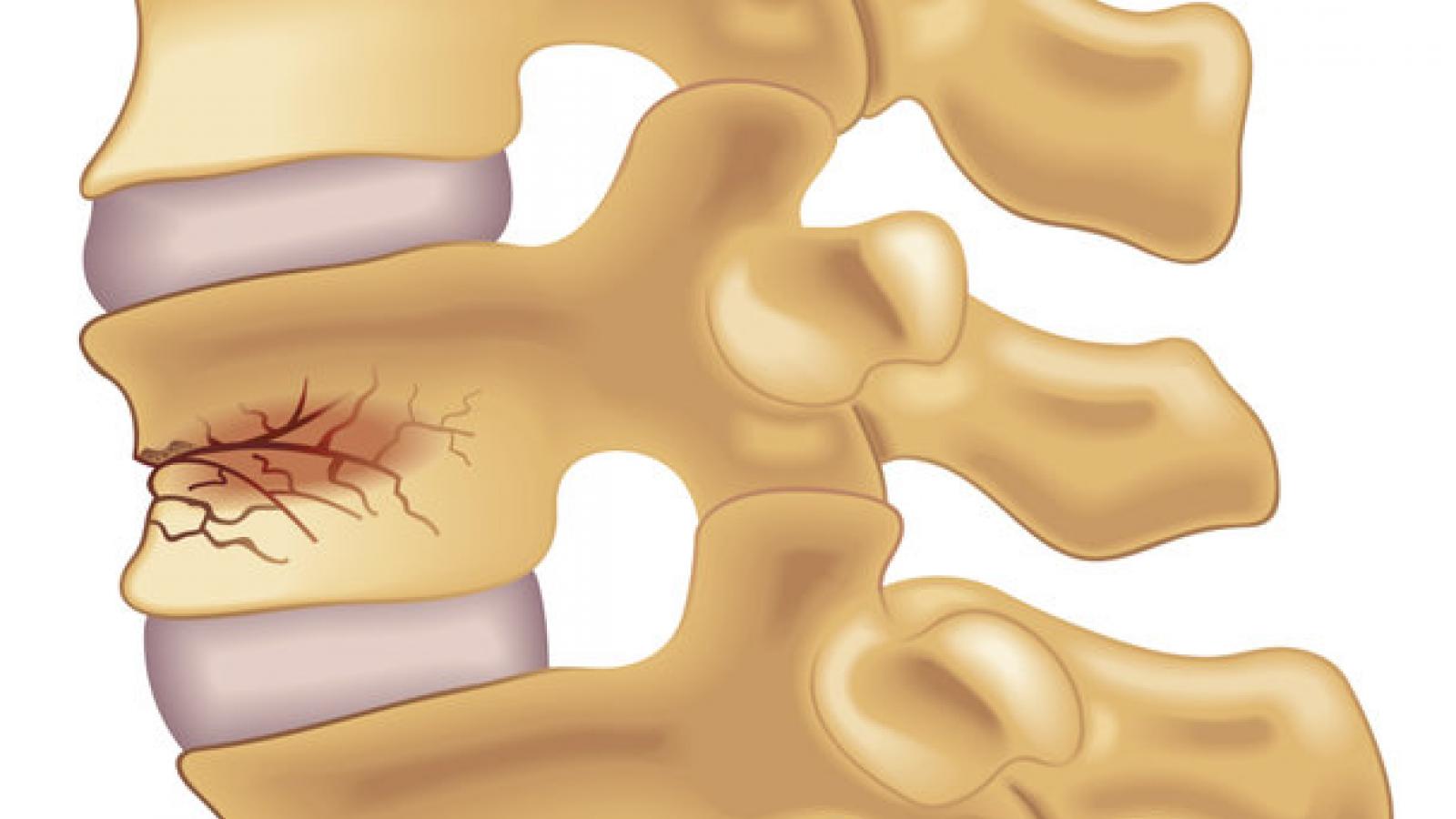 Vertbral,Fracture,spine,compression