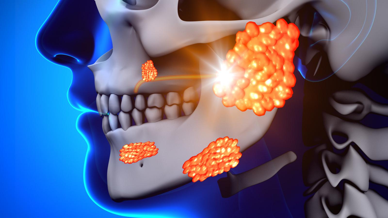 Mumps,Parotid