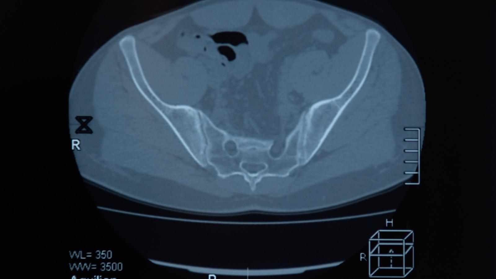 SI,Sacroiliac,Erosion,MRI