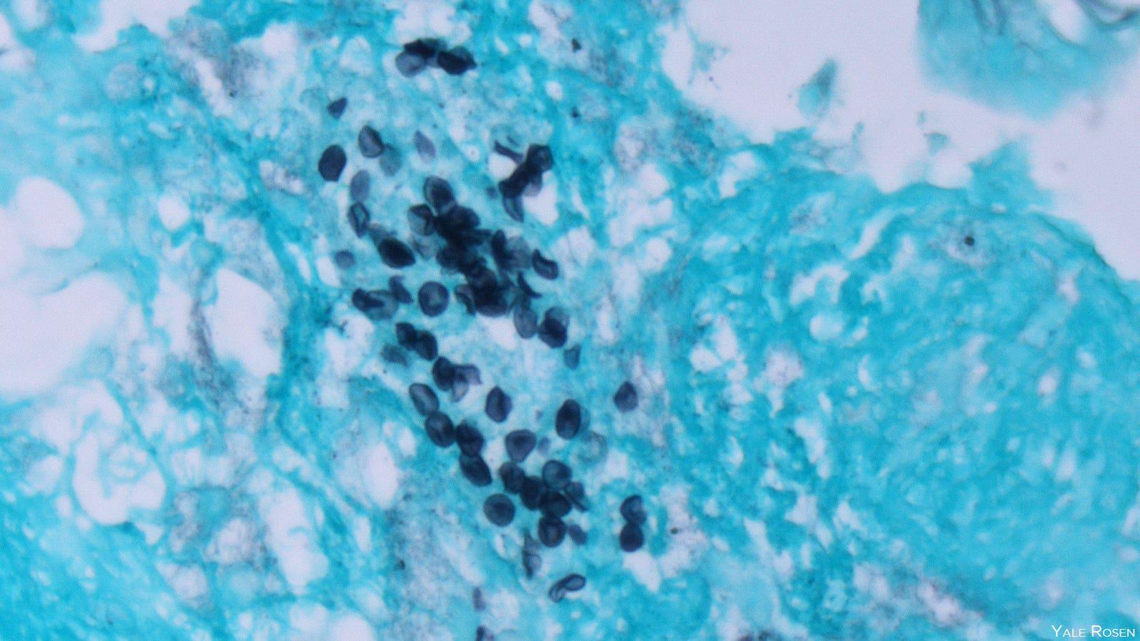 infection pneumonia