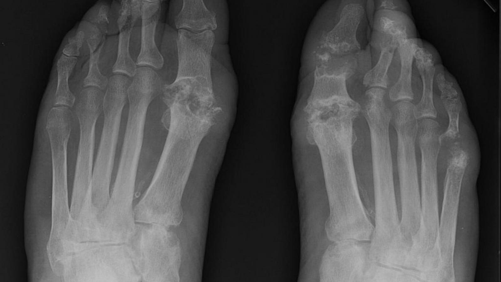 gout,MTP,tophi