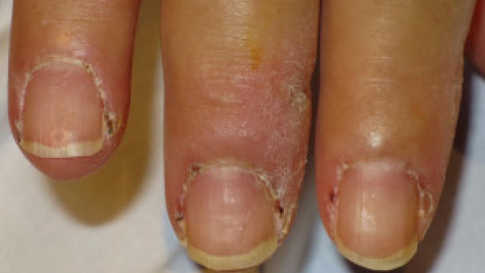 antisynthetase,myositis,nail,erythema