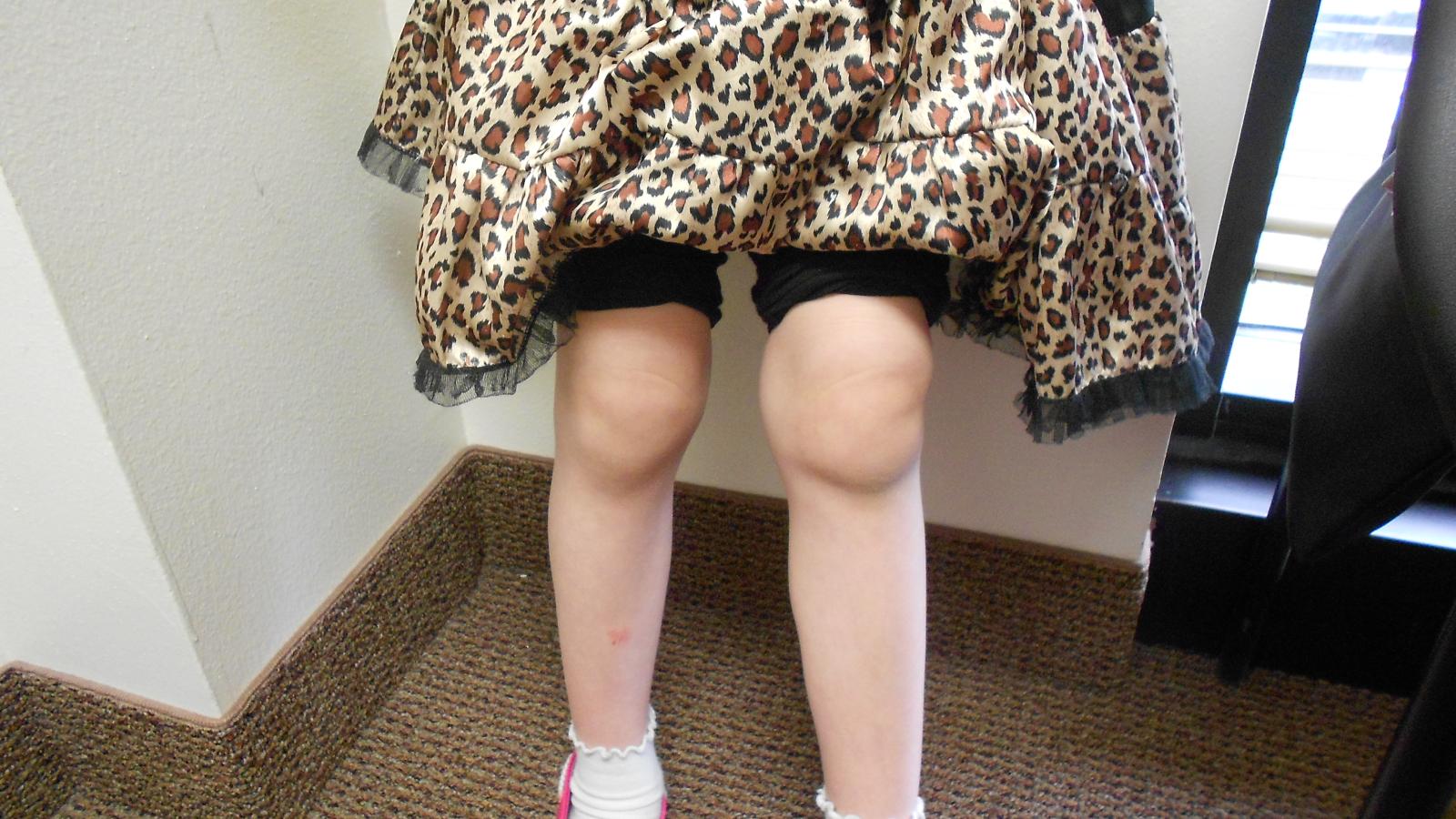 JIA,knee,synovitis