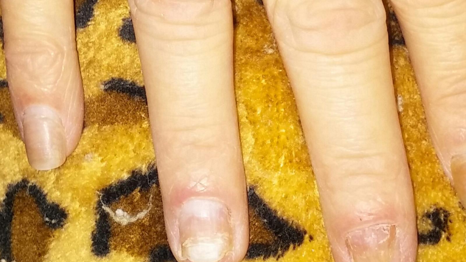 PsA, PSO, nail