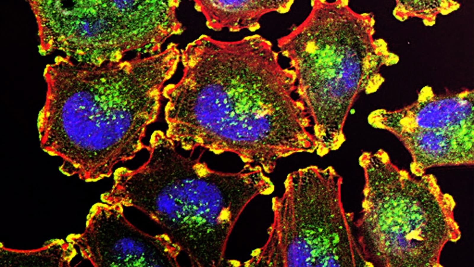 cancer, melanoma, metastatic, cell