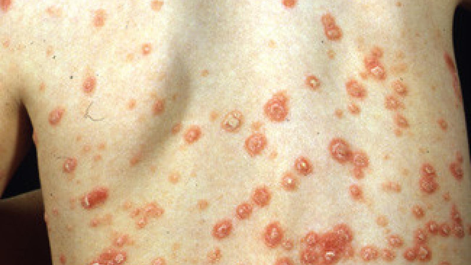 child.guttate.psoriasis
