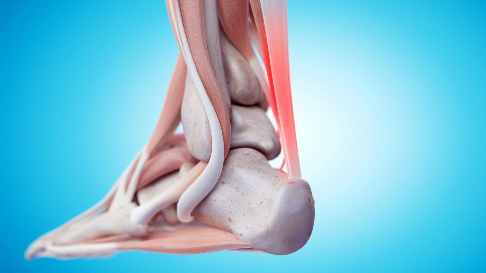 Achilles,ankle,heel