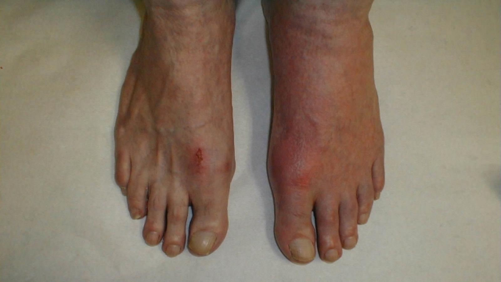 MTP1,gout