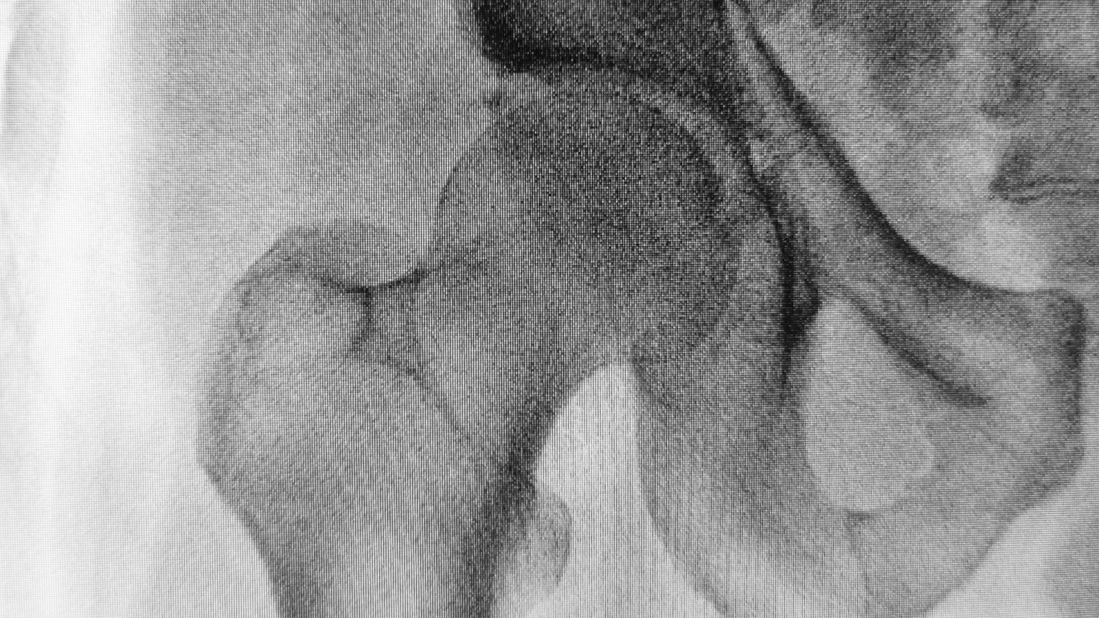 hip,fracture3