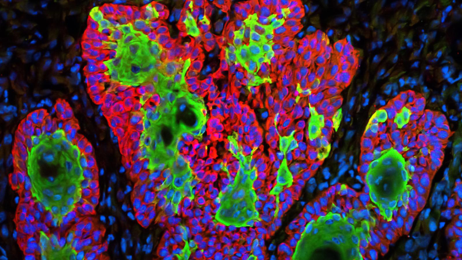 Skin,cancer,squamous,cell