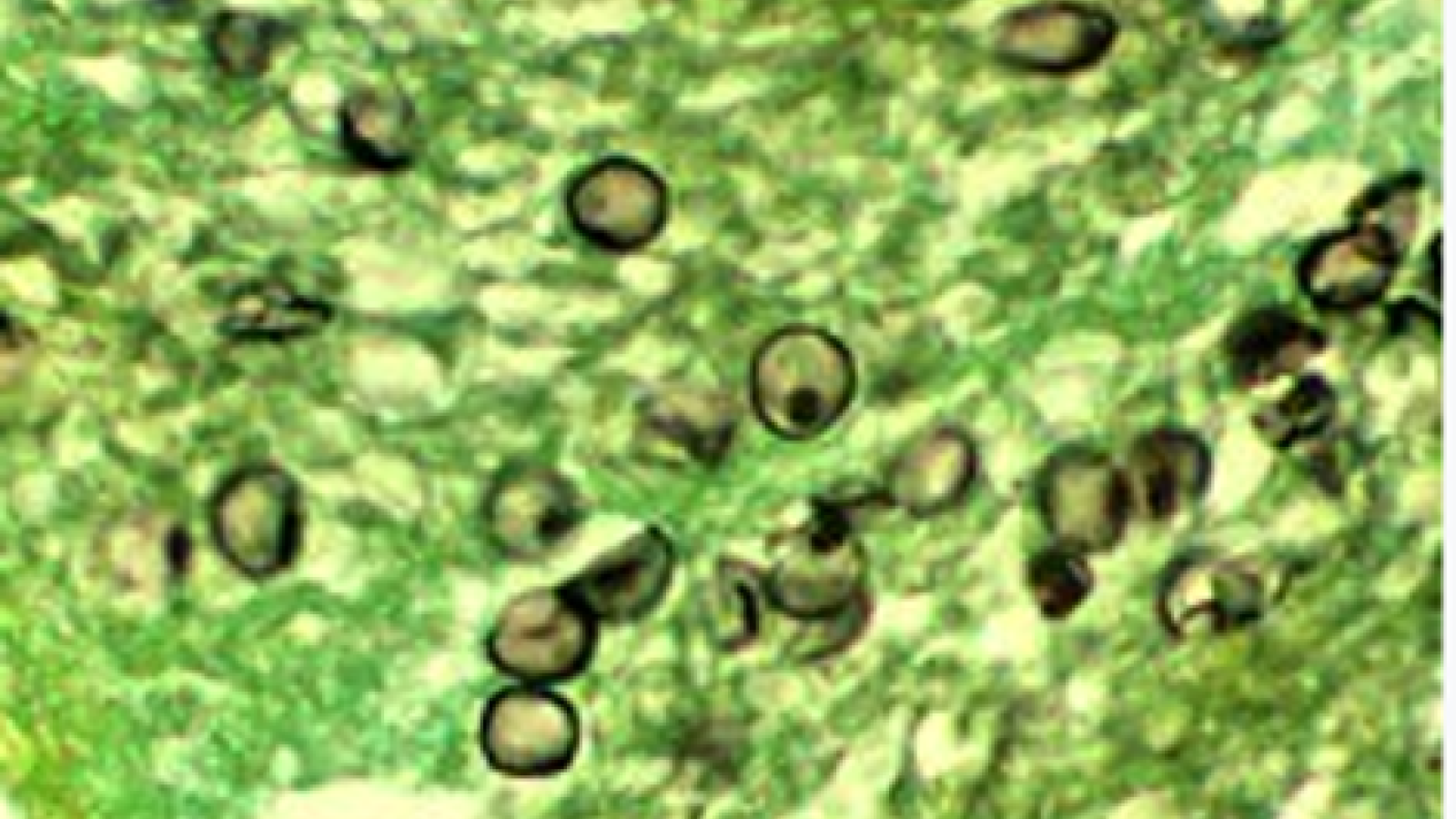 pneumocystis,PJP