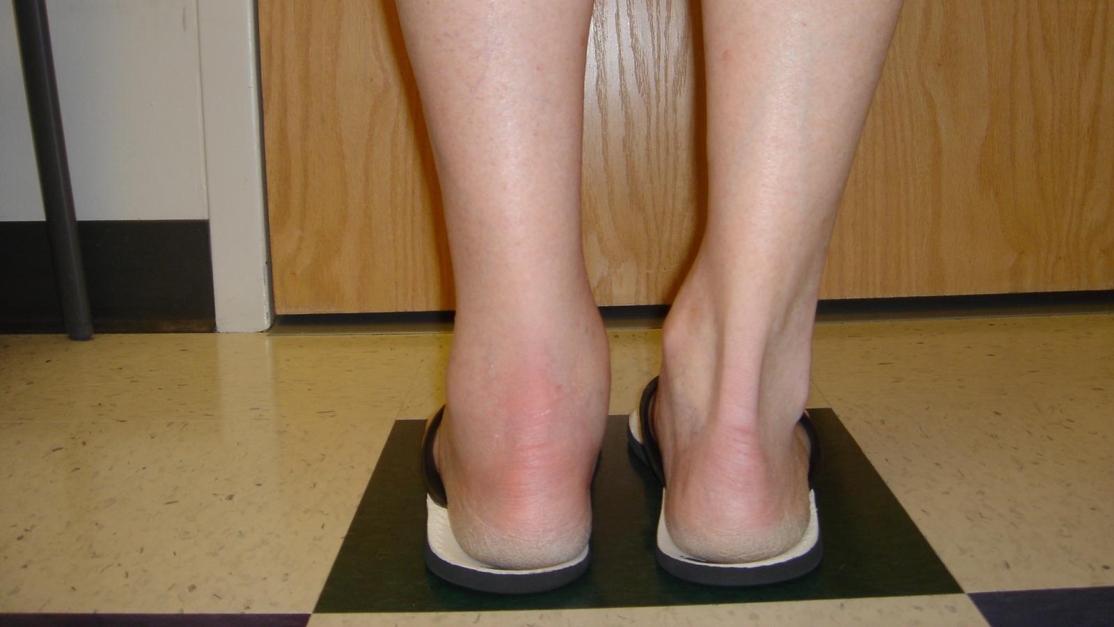 Heel, pain,enthesitis,achilles
