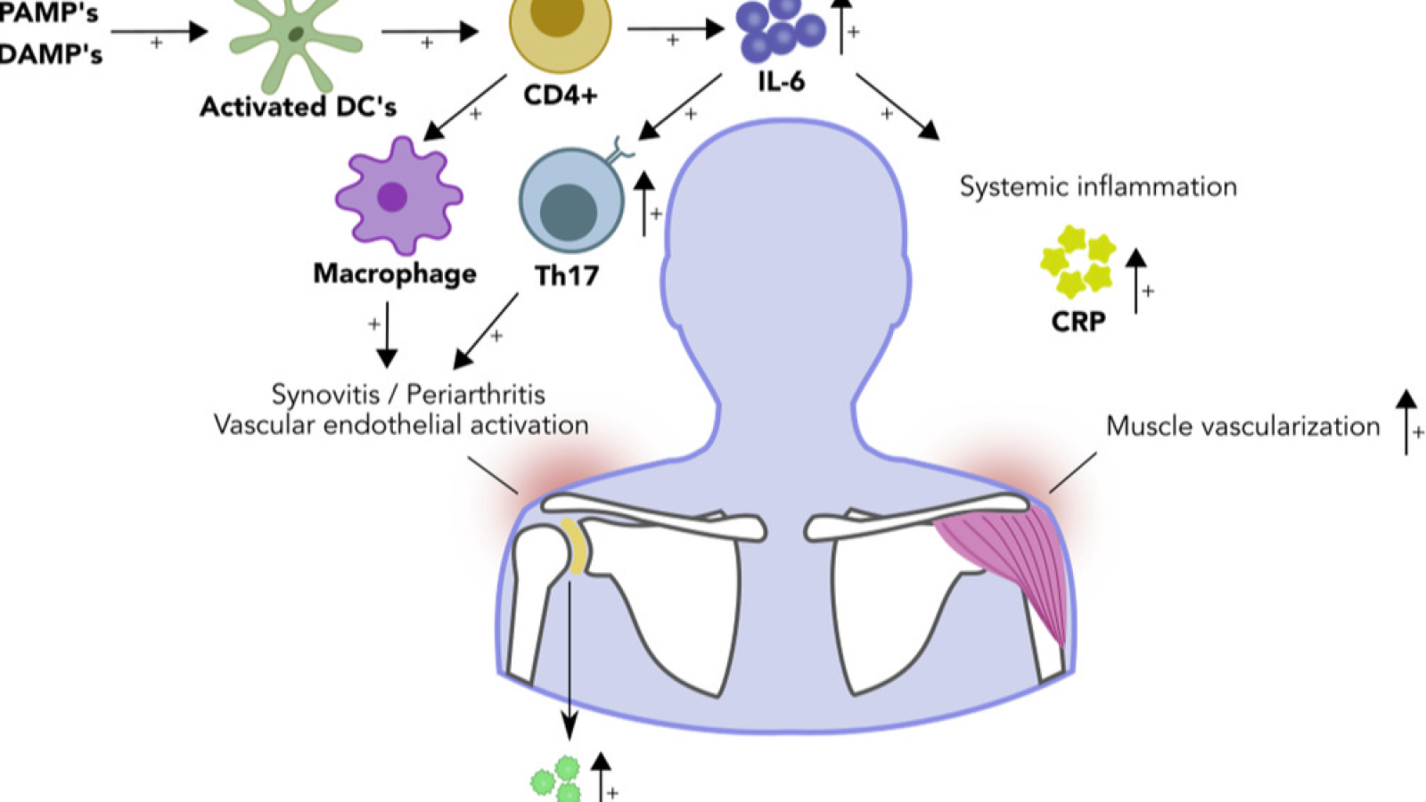 PMR,pathogenesis.JIM2022