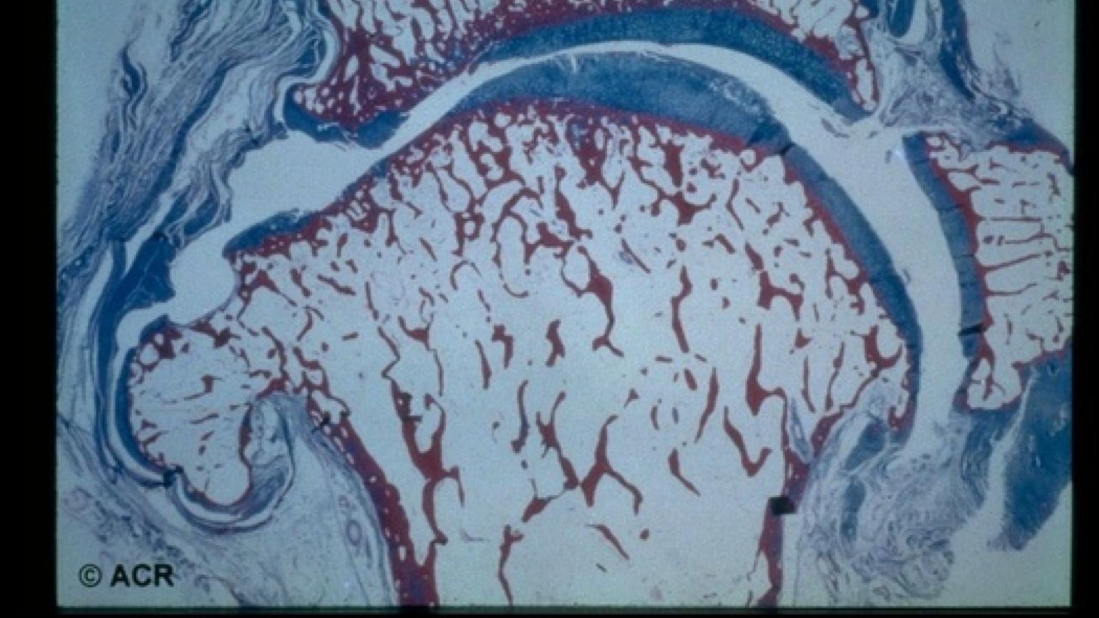DJD,OA,Cartilage
