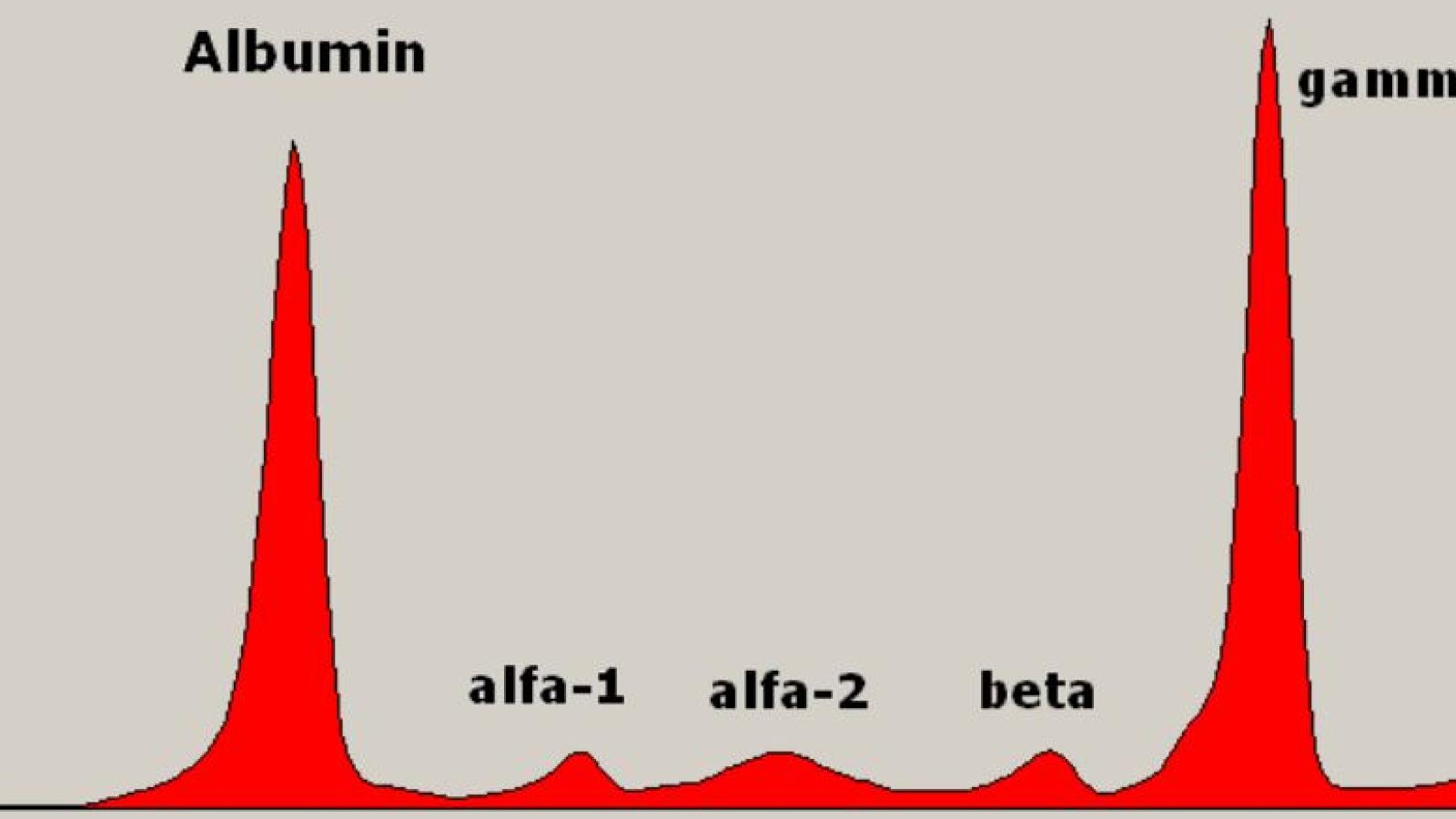 MGUS,SPEP,Gamma