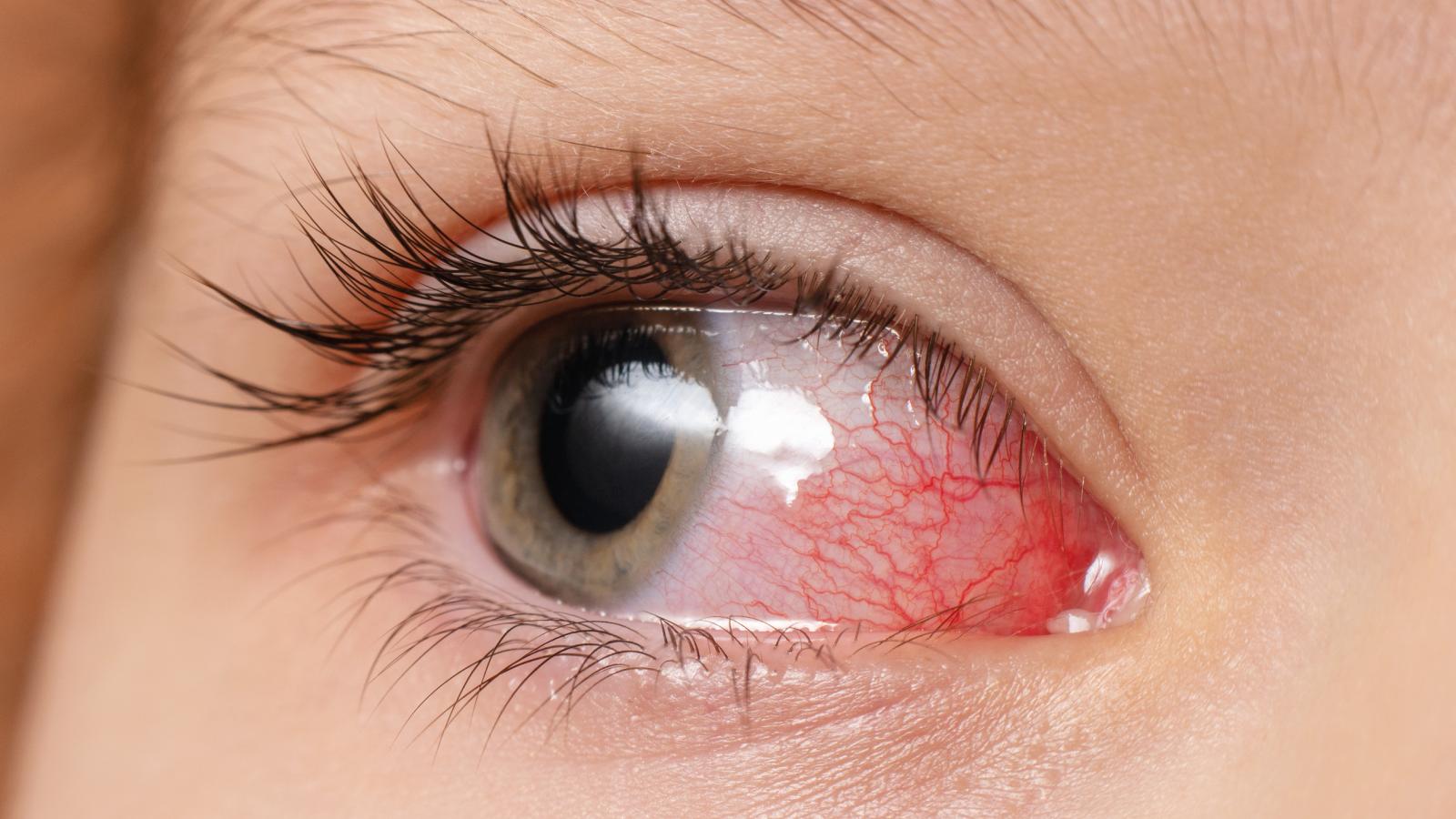 pediatric eye uveitis