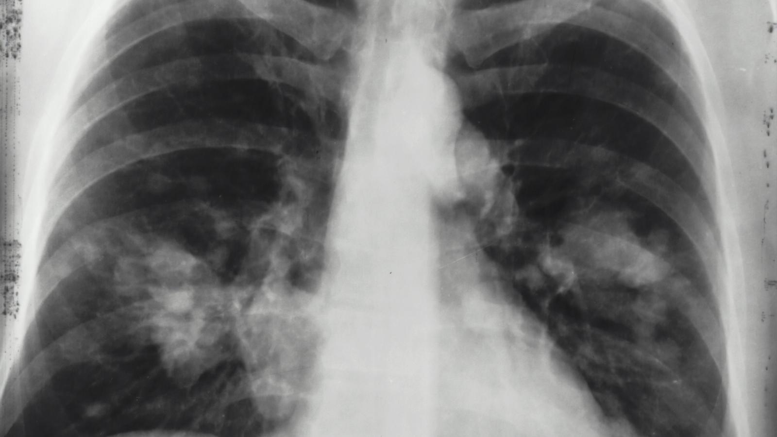 Lung,cancer,nci