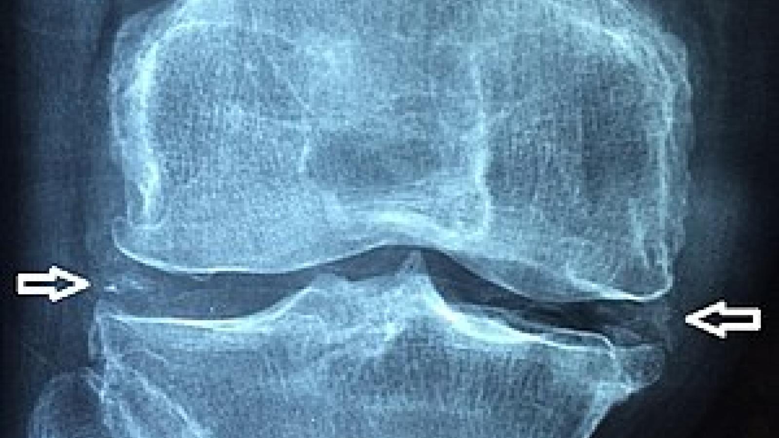 Chondrocalcinosis