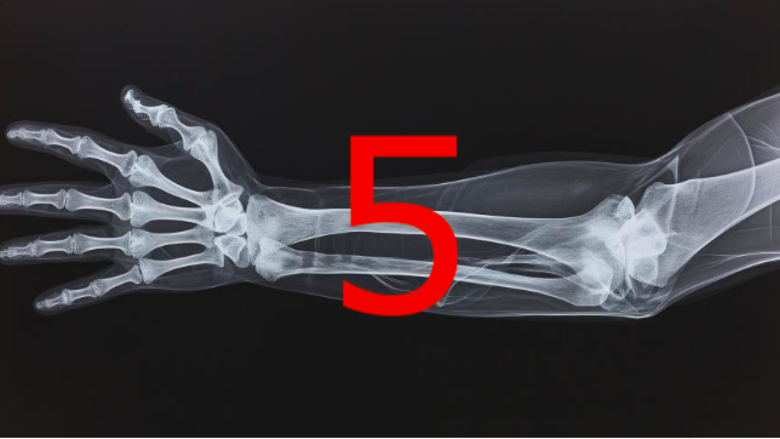 5 fractures