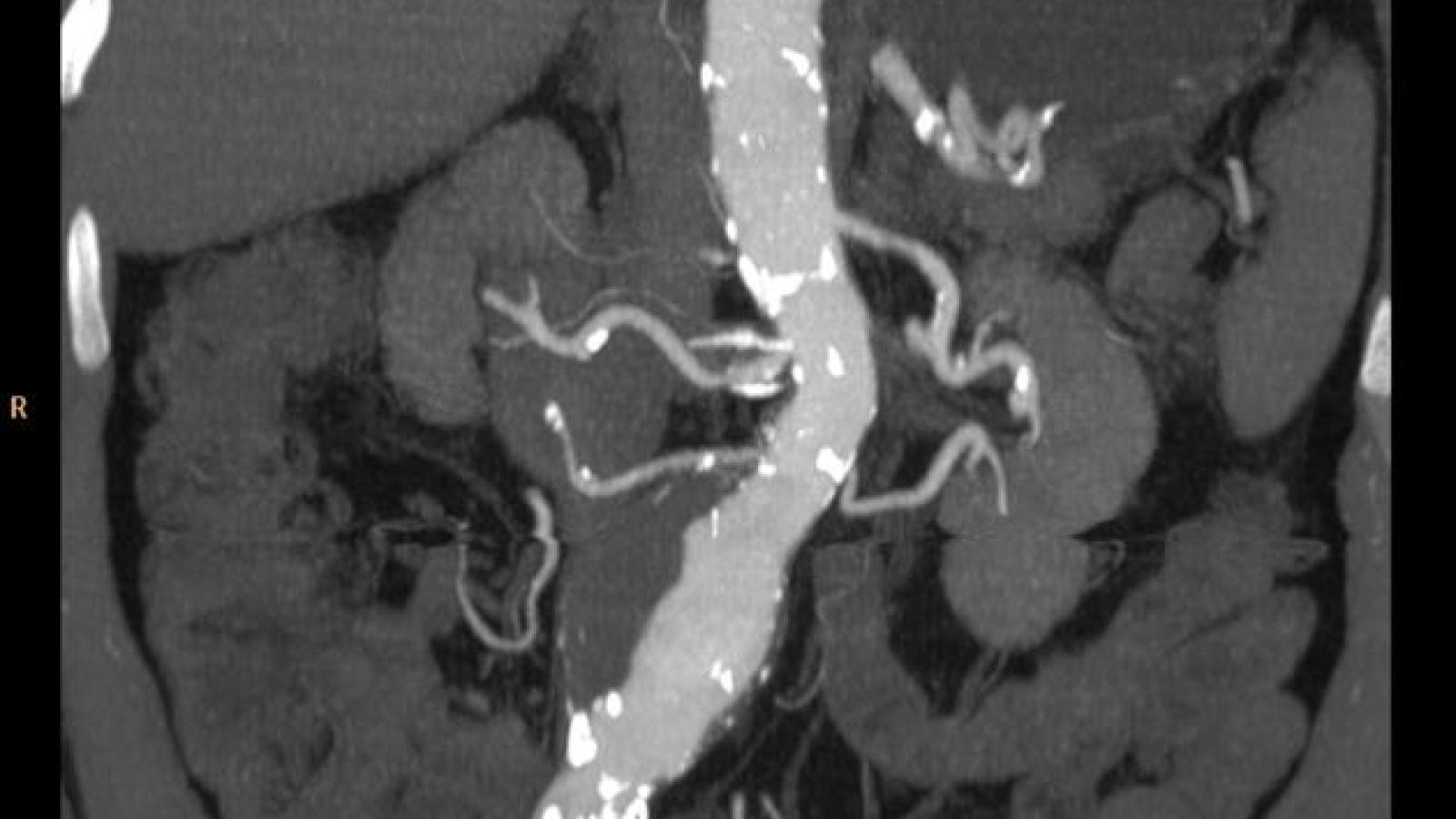 Aorta